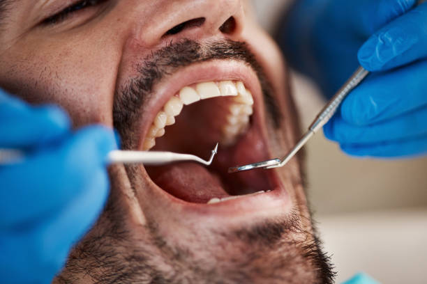 Best Emergency Wisdom Tooth Extraction in Hampstead, NC